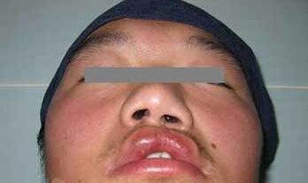 唇裂修复手术需要花多少钱 唇裂修复手术哪家医院喜欢