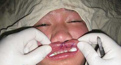 唇裂修复手术需要花多少钱 唇裂修复手术哪家医院喜欢