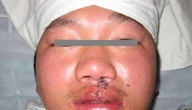 唇裂修复手术需要花多少钱 唇裂修复手术哪家医院喜欢