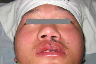 唇裂修复手术需要花多少钱 唇裂修复手术哪家医院喜欢