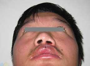 唇裂修复手术需要花多少钱 唇裂修复手术哪家医院喜欢