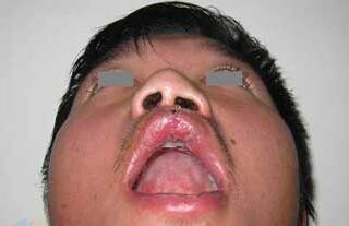 唇裂修复手术需要花多少钱 唇裂修复手术哪家医院喜欢