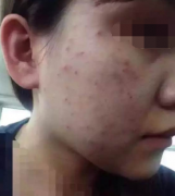 果酸换肤一次大概多少钱 果酸换肤有副作用吗