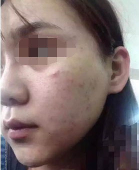 果酸换肤一次大概多少钱 果酸换肤有副作用吗