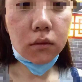 果酸换肤一次大概多少钱 果酸换肤有副作用吗