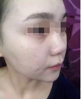 果酸换肤一次大概多少钱 果酸换肤有副作用吗