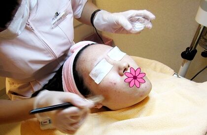 果酸换肤一次大概多少钱 果酸换肤有副作用吗