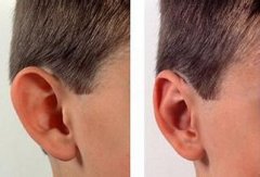 招风耳矫正手术要多少钱 招风耳手术前后对比图
