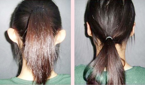 招风耳矫正手术要多少钱 招风耳手术前后对比图