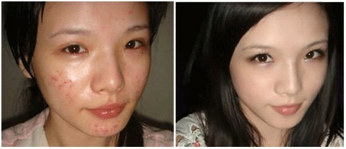 像素激光去痘坑好吗 像素激光去痘疤果如何