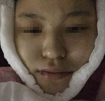 整成瓜子脸需要多少钱价格 整形瓜子脸需要多少钱价格 整个瓜子脸需要多少钱价格