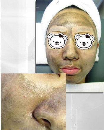 如何使面部毛孔收缩 收缩毛孔手术去黑头