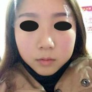 注射打注射瘦脸溶脂B****成好吗 注射打注射瘦脸溶脂B****瘦脸果怎么样好不好