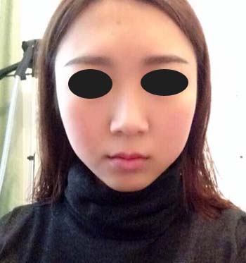 注射打注射瘦脸溶脂B****成好吗 注射打注射瘦脸溶脂B****瘦脸果怎么样好不好