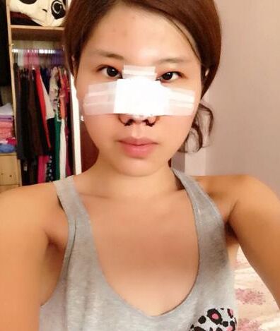 鼻孔缩小手术果对比照片案例图 鼻孔缩小手术价格多少钱