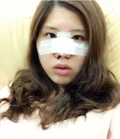 鼻孔缩小手术果对比照片案例图 鼻孔缩小手术价格多少钱