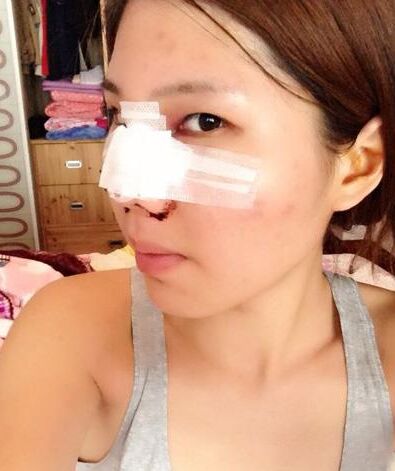 鼻孔缩小手术果对比照片案例图 鼻孔缩小手术价格多少钱