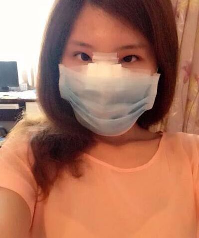 鼻孔缩小手术果对比照片案例图 鼻孔缩小手术价格多少钱