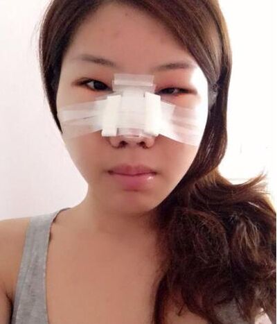 鼻孔缩小手术果对比照片案例图 鼻孔缩小手术价格多少钱