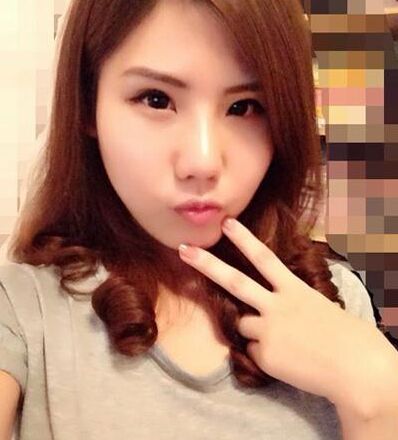 鼻孔缩小手术果对比照片案例图 鼻孔缩小手术价格多少钱
