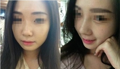 鼻孔缩小手术果对比照片案例图 鼻孔缩小手术价格多少钱