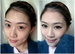 激光全身美白大概需要多少钱价格 全身激光美白费用大概需要多少钱