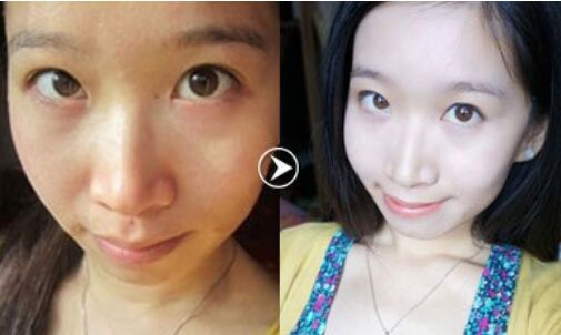 激光全身美白大概需要多少钱价格 全身激光美白费用大概需要多少钱