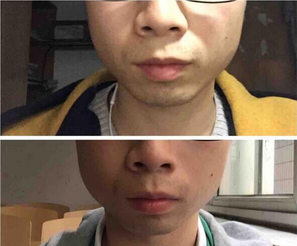 注射打注射瘦脸B****瘦脸的价格多少钱 注射打注射瘦脸除皱美容的价格多少钱
