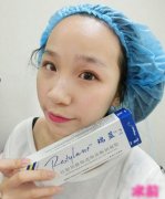 注射打玻尿酸隆鼻前后对比果照片图 注射打玻尿酸隆鼻可以能够维持多久
