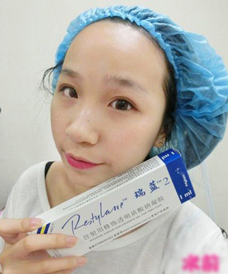 注射打玻尿酸隆鼻前后对比果照片图 注射打玻尿酸隆鼻可以能够维持多久