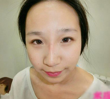 注射打玻尿酸隆鼻前后对比果照片图 注射打玻尿酸隆鼻可以能够维持多久