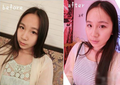 注射打玻尿酸隆鼻前后对比果照片图 注射打玻尿酸隆鼻可以能够维持多久