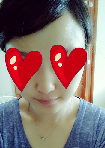 注射打玻尿酸隆鼻前后对比果照片图 注射打玻尿酸隆鼻可以能够维持多久