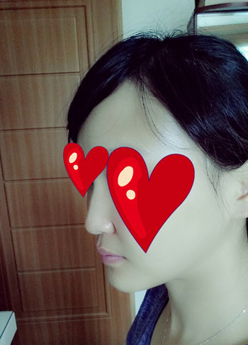 注射打玻尿酸隆鼻前后对比果照片图 注射打玻尿酸隆鼻可以能够维持多久