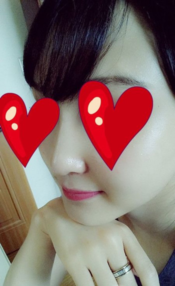 注射打玻尿酸隆鼻前后对比果照片图 注射打玻尿酸隆鼻可以能够维持多久