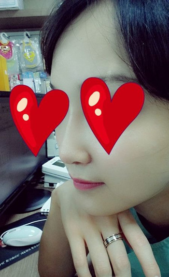 注射打玻尿酸隆鼻前后对比果照片图 注射打玻尿酸隆鼻可以能够维持多久