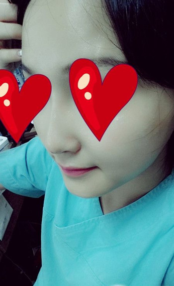 注射打玻尿酸隆鼻前后对比果照片图 注射打玻尿酸隆鼻可以能够维持多久