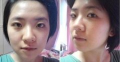 自体软骨隆鼻手术大概需要花多少钱价格 自体软骨隆鼻手术前后对比恢复过程果照片图 自体软骨隆鼻手术大概需要花多少钱价格 自体软骨隆鼻手术前后对比恢复过程果照片图