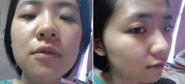 自体软骨隆鼻手术大概需要花多少钱价格 自体软骨隆鼻手术前后对比恢复过程果照片图