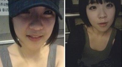 自体软骨隆鼻手术大概需要花多少钱价格 自体软骨隆鼻手术前后对比恢复过程果照片图