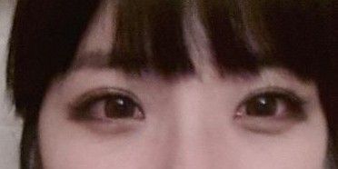 自体软骨隆鼻手术大概需要花多少钱价格 自体软骨隆鼻手术前后对比恢复过程果照片图