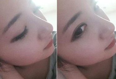 自体软骨隆鼻手术大概需要花多少钱价格 自体软骨隆鼻手术前后对比恢复过程果照片图