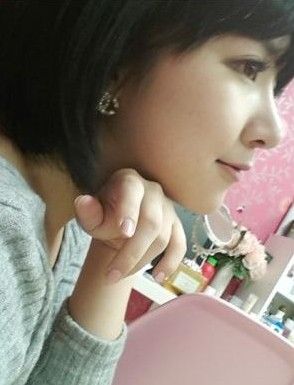 自体软骨隆鼻手术大概需要花多少钱价格 自体软骨隆鼻手术前后对比恢复过程果照片图