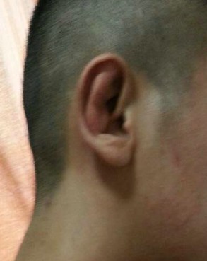 招风耳矫正手术怎么做 招风耳矫正整形手术一般大概要多少钱价格