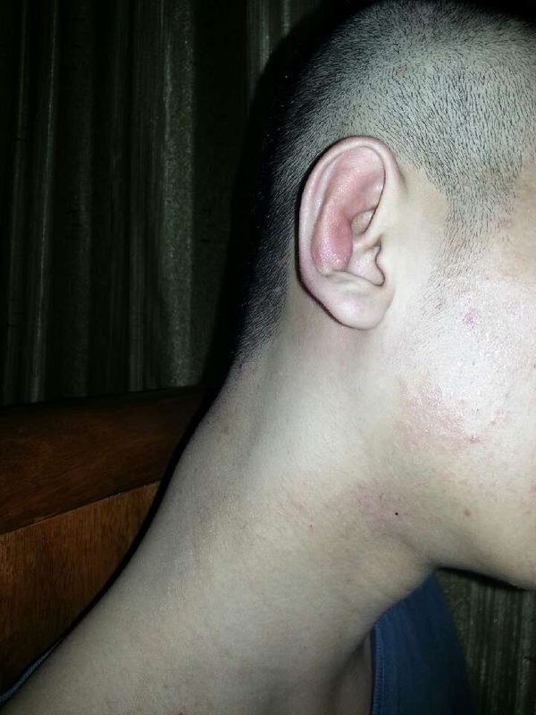 招风耳矫正手术怎么做 招风耳矫正整形手术一般大概要多少钱价格