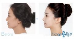 人中延长术（philtrum lengthening）前后果对比图