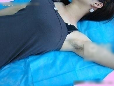 冰点e光脱毛的价格是多少钱 冰点e光脱毛的价格表