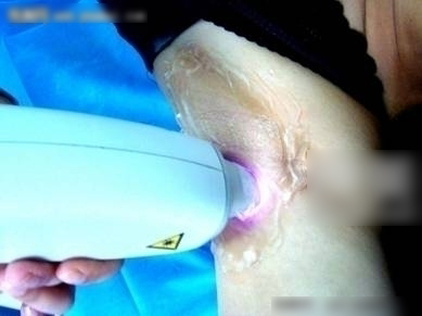 冰点e光脱毛的价格是多少钱 冰点e光脱毛的价格表