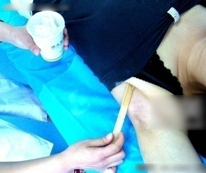 冰点e光脱毛的价格是多少钱 冰点e光脱毛的价格表