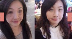 怎么去除脸上的老年斑 如何去除脸上的老年斑
